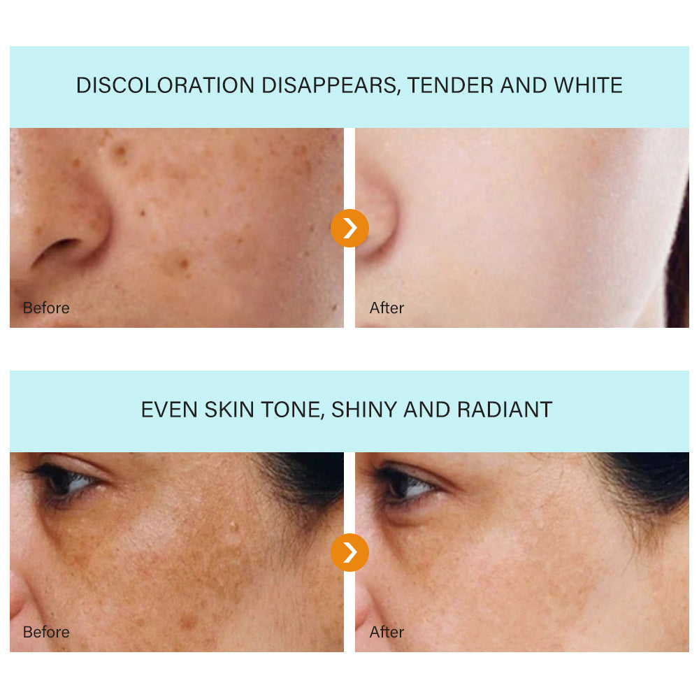 DARK SPOT REMOVAL CREAM Acne Scars Melasma Hydrating Whitening Cream for All Skin Types