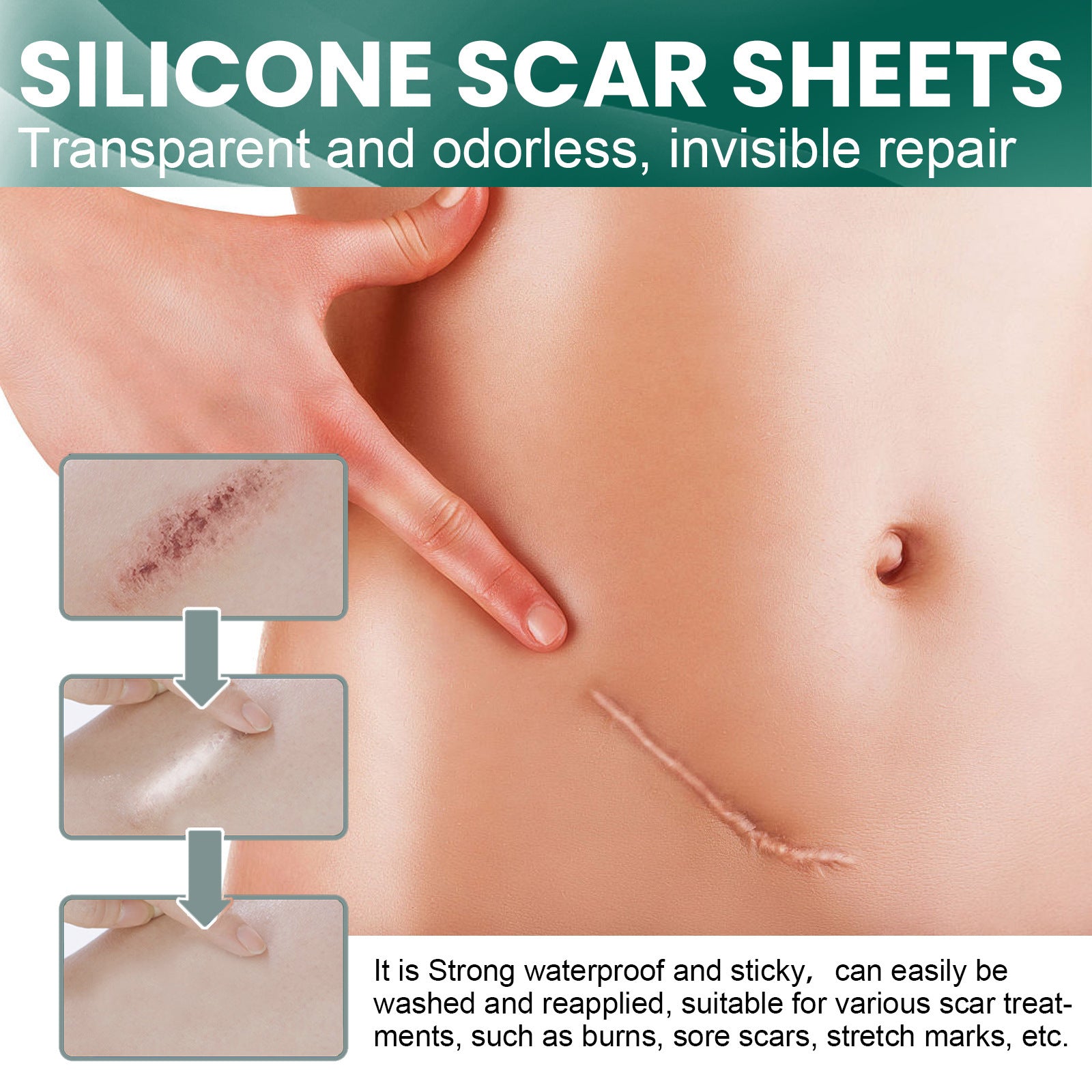 Silicone Scar Tape Sheets Roll - Improves and lightens scars, suitable for keloid and hypertrophic scars, size can be cut to fit