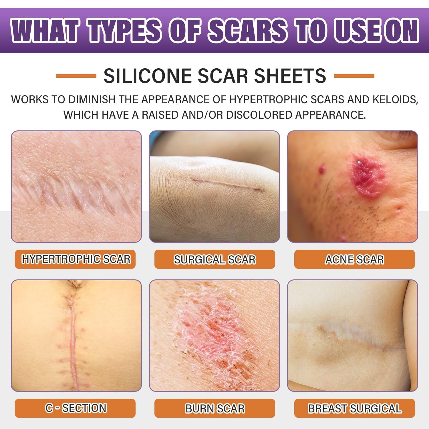 Silicone Scar Tape Sheets Roll - Improves and lightens scars, suitable for keloid and hypertrophic scars, size can be cut to fit