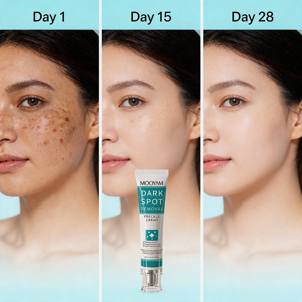 MOOYAM Dark Spot Removal Freckle Cream - Reduces dark spots, fades freckles and evens skin tone for a clearer, brighter complexion