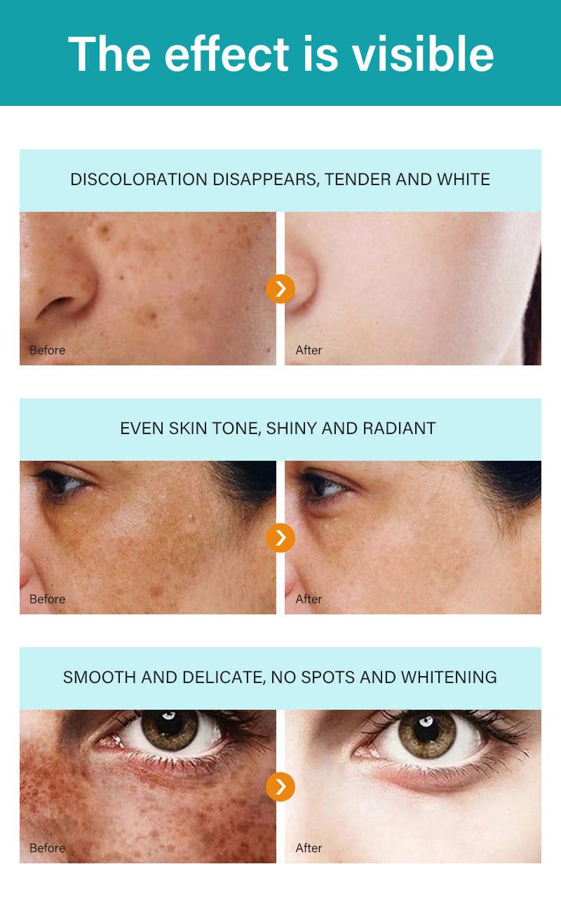 MOOYAM Dark Spot Removal Freckle Cream - Reduces dark spots, fades freckles and evens skin tone for a clearer, brighter complexion