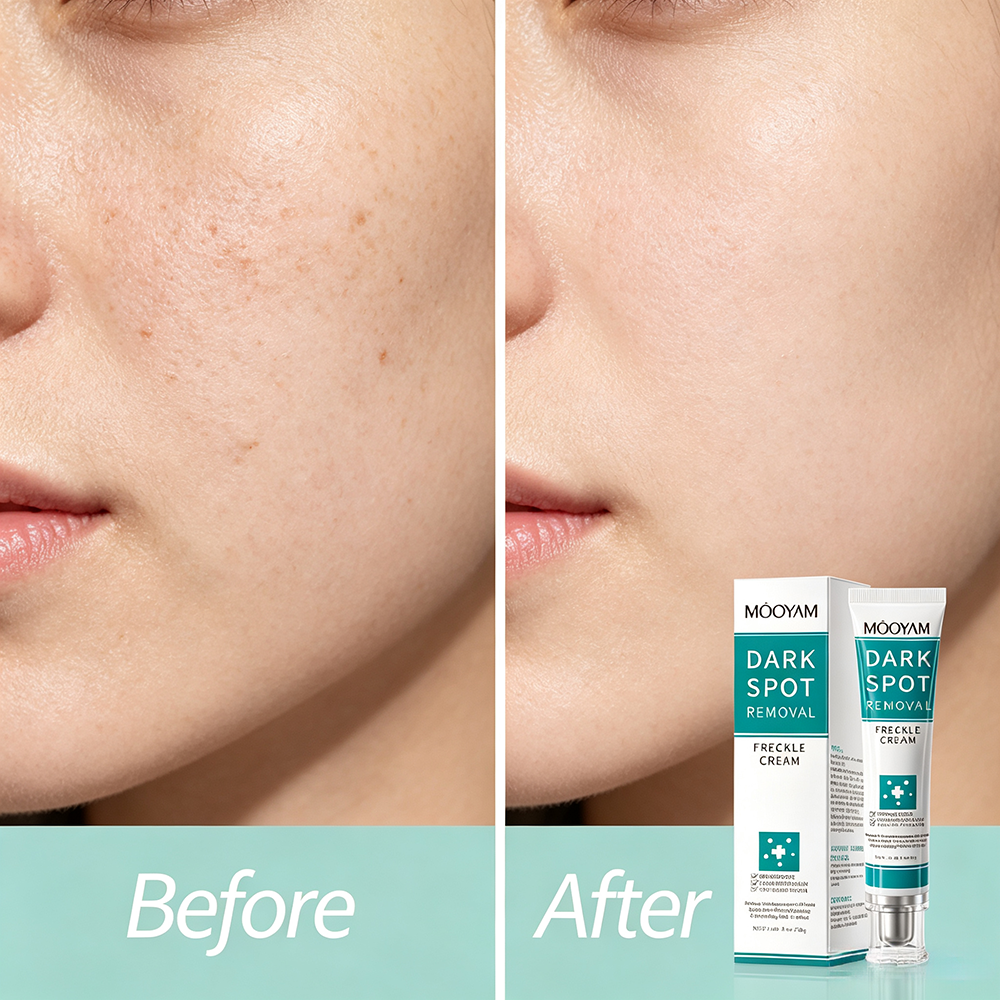 MOOYAM Dark Spot Removal Freckle Cream - Reduces dark spots, fades freckles and evens skin tone for a clearer, brighter complexion