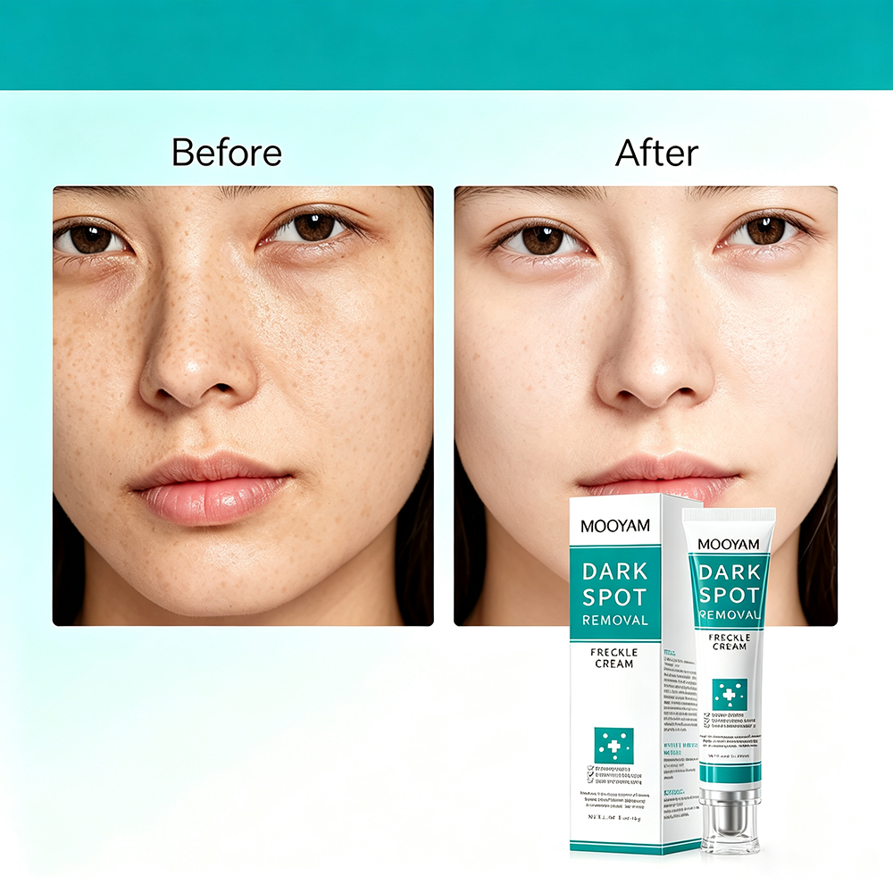 MOOYAM Dark Spot Removal Freckle Cream - Reduces dark spots, fades freckles and evens skin tone for a clearer, brighter complexion