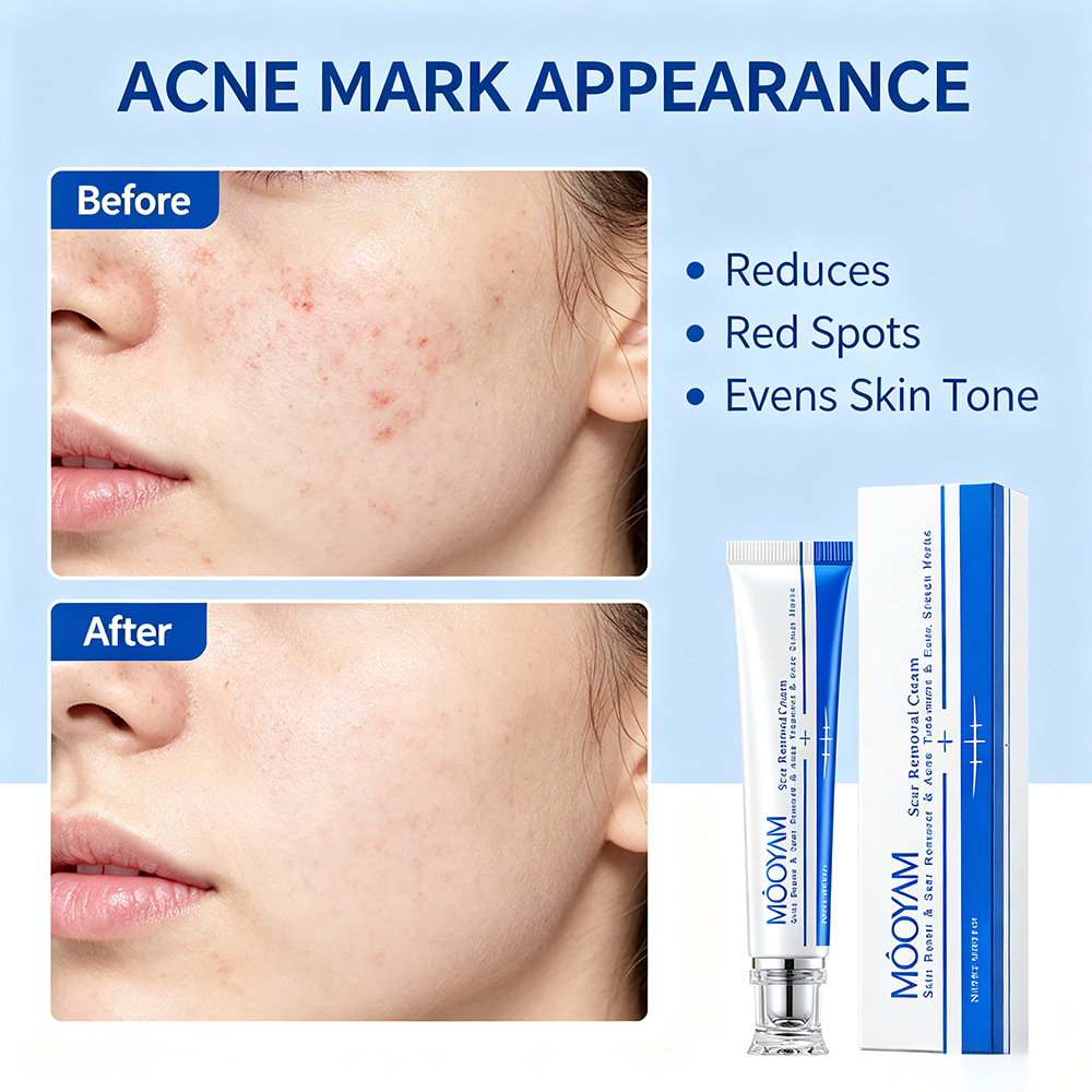 MOOYAM Scar Removal Cream tube and box, Skin Repair & Scar Remover & Acne Treatment & Fade Stretch Marks, 1.06 fl oz