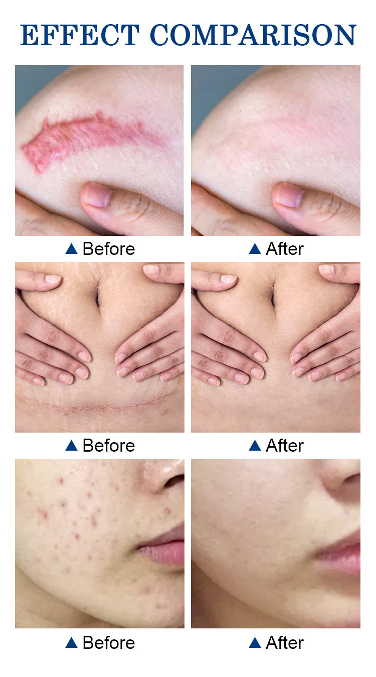 MOOYAM Scar Removal Cream tube and box, Skin Repair & Scar Remover & Acne Treatment & Fade Stretch Marks, 1.06 fl oz