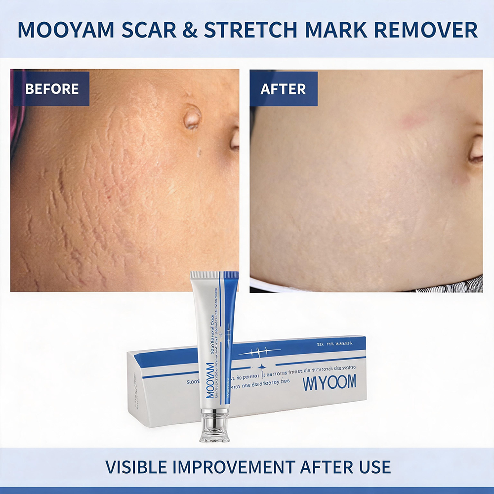 MOOYAM Scar Removal Cream tube and box, Skin Repair & Scar Remover & Acne Treatment & Fade Stretch Marks, 1.06 fl oz