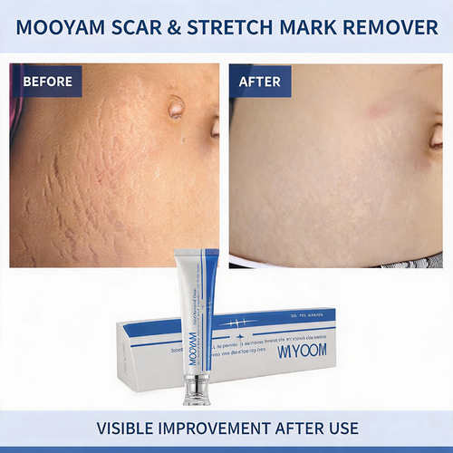 MOOYAM Scar Removal Cream tube and box, Skin Repair & Scar Remover & Acne Treatment & Fade Stretch Marks, 1.06 fl oz