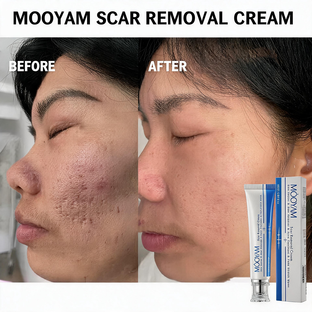 MOOYAM Scar Removal Cream tube and box, Skin Repair & Scar Remover & Acne Treatment & Fade Stretch Marks, 1.06 fl oz