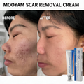 MOOYAM Scar Removal Cream tube and box, Skin Repair & Scar Remover & Acne Treatment & Fade Stretch Marks, 1.06 fl oz