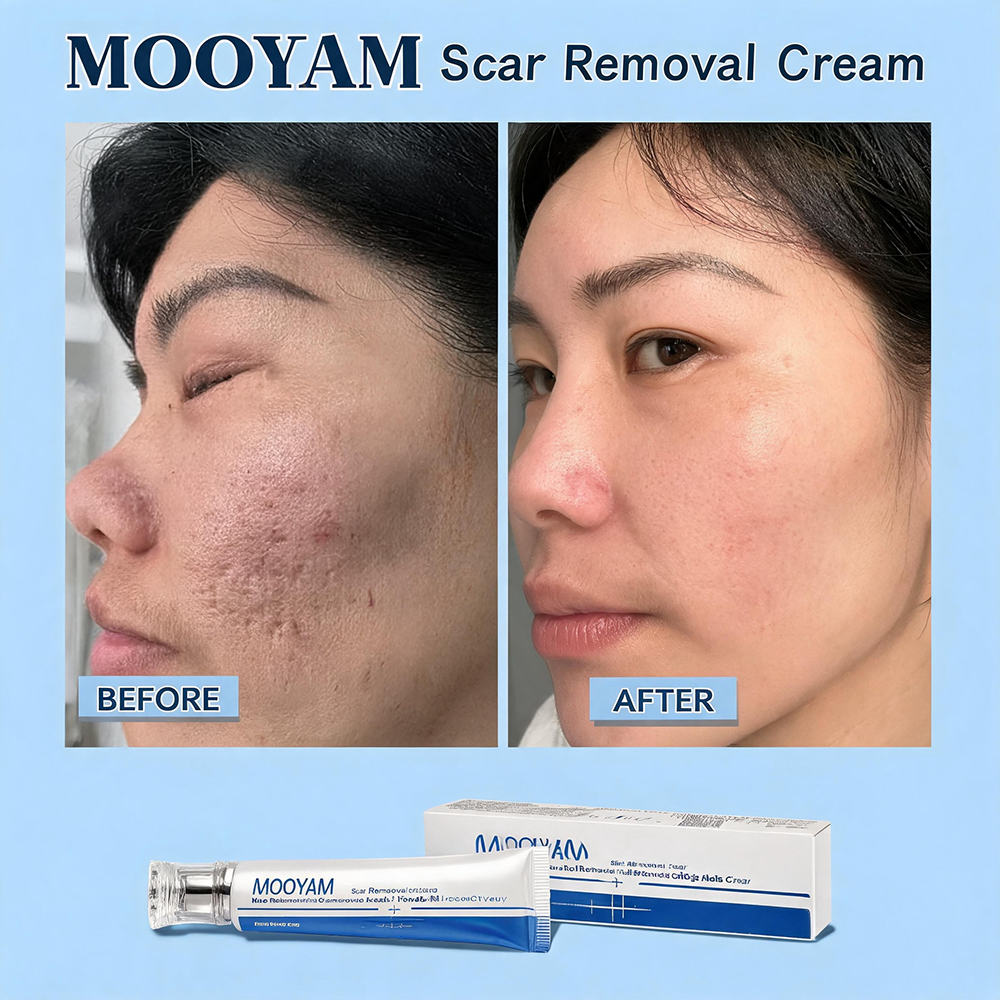 MOOYAM Scar Removal Cream tube and box, Skin Repair & Scar Remover & Acne Treatment & Fade Stretch Marks, 1.06 fl oz