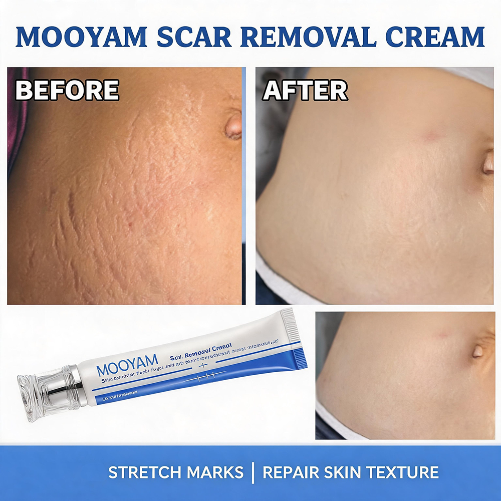 MOOYAM Scar Removal Cream tube and box, Skin Repair & Scar Remover & Acne Treatment & Fade Stretch Marks, 1.06 fl oz