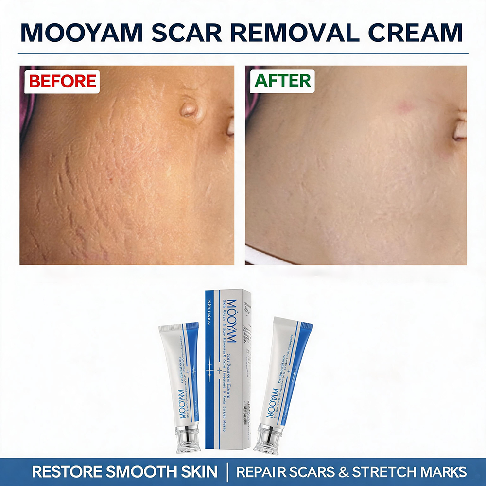 MOOYAM Scar Removal Cream tube and box, Skin Repair & Scar Remover & Acne Treatment & Fade Stretch Marks, 1.06 fl oz