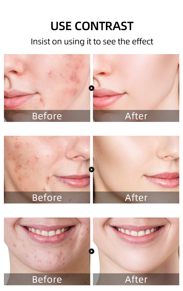 Salicylic Acid Acne Cream Treatment For Pimples Blackheads Herbal Extract Fast Repairing Skin Care