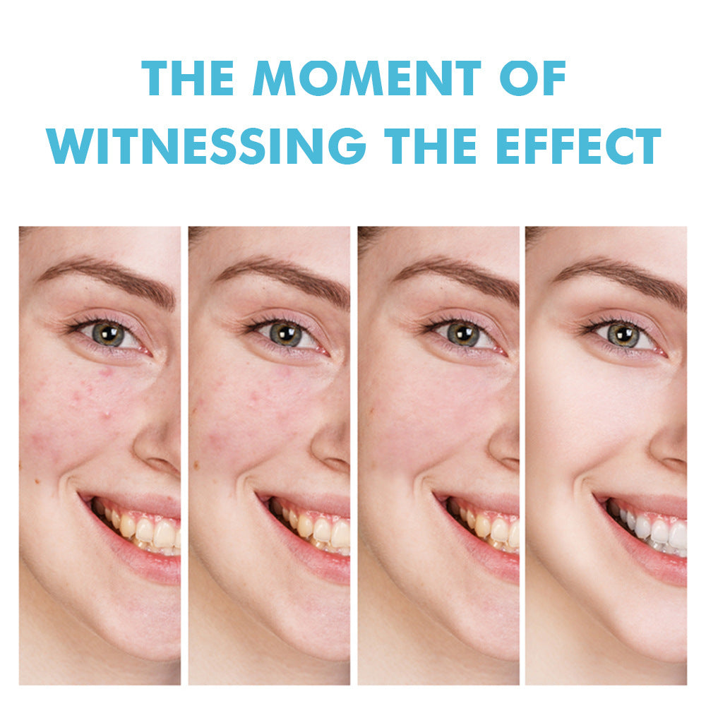 Salicylic Acid Acne Cream Treatment For Pimples Blackheads Herbal Extract Fast Repairing Skin Care