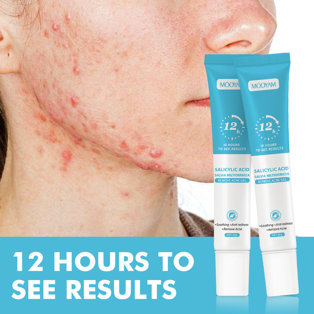 Salicylic Acid Acne Cream Treatment For Pimples Blackheads Herbal Extract Fast Repairing Skin Care